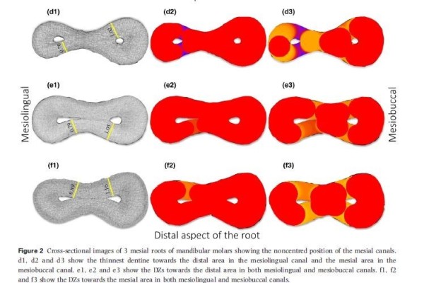 Anatomical Danger Zone Reconsidered: A Micro-CT Study on Dentine Thickness in Mandibular Molars